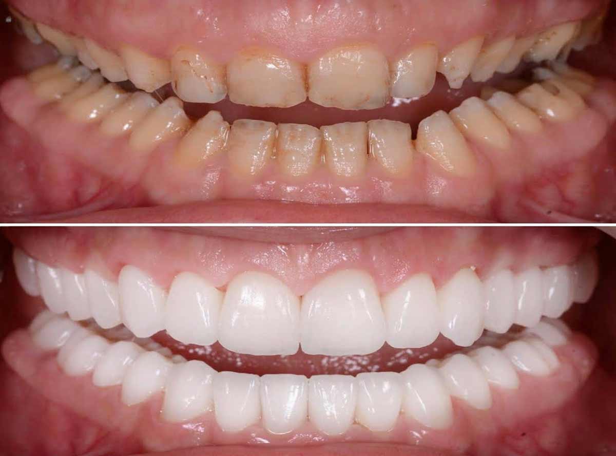 Full-Arch Comparison
