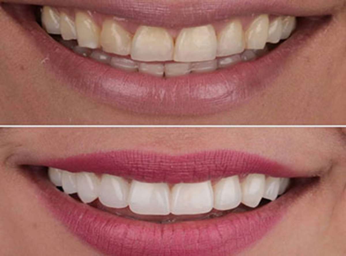 Margaret W. - Toulouse - Smile Design (20 Veneers)