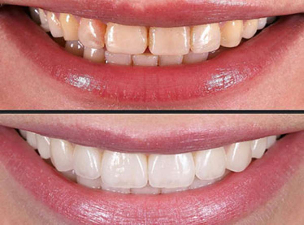 Veneers / Smile Design, 5–7 Days