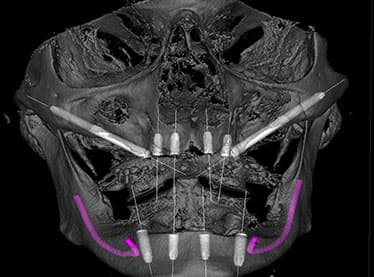Karen T. - Lyon - Zygomatic Implants
