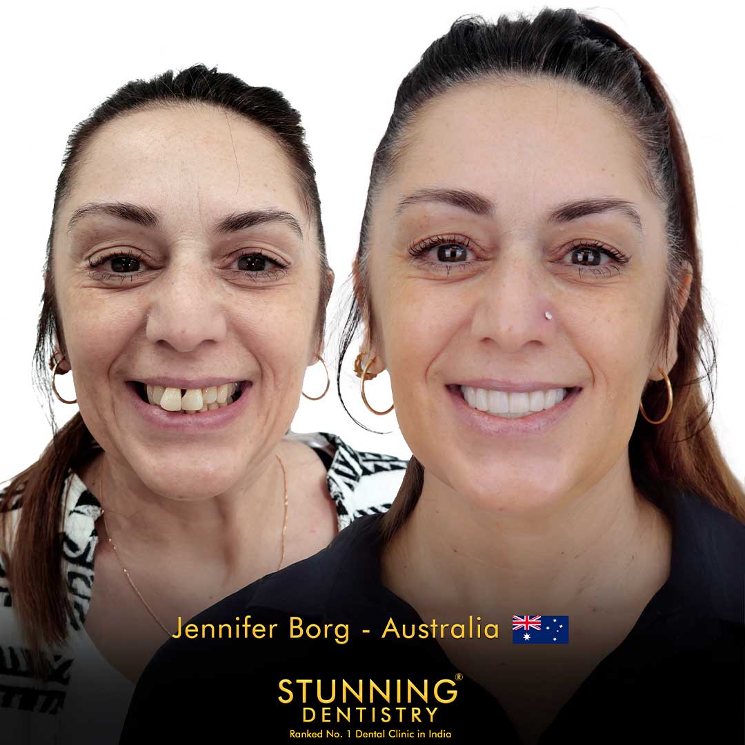 Full Mouth Rehabilitation - photo 1