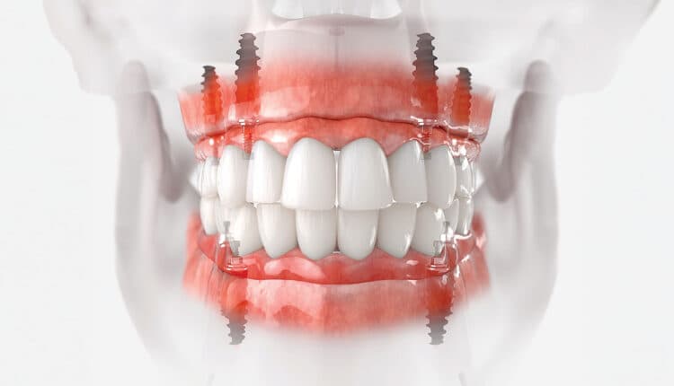 Full-Arch Rehabilitation