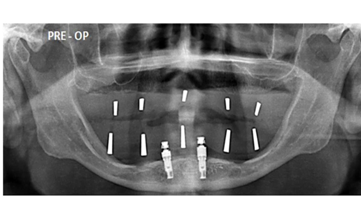 When Basal Implants Are Indicated <!-- viewport: condense tablet -->