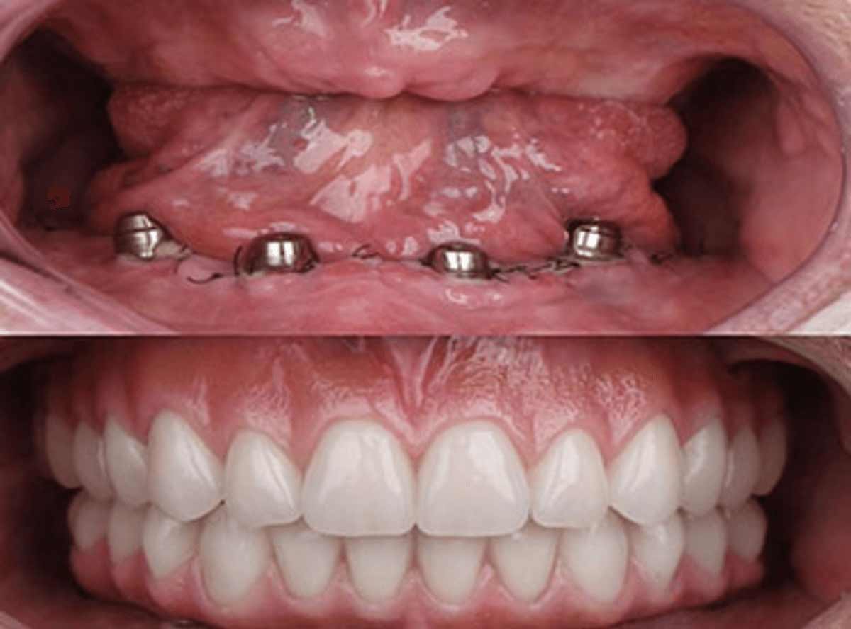Decision Framework: Overdenture vs Fixed Full-Arch <!-- viewport: condense tablet -->